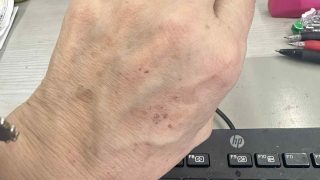 手の甲のシミが薄くなったよ　嬉しいご報告