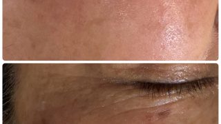 神戸三宮　シミが濃くなる人と薄くなる人の違い　肌再生の力